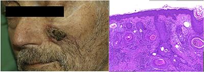 Serum Troponin T Concentrations Are Frequently Elevated in Advanced Skin Cancer Patients Prior to Immune Checkpoint Inhibitor Therapy: Experience From a Single Tertiary Referral Center